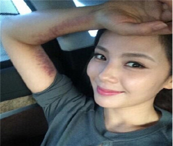 刘涛刮痧调“心病” 心脏不好慎刮痧